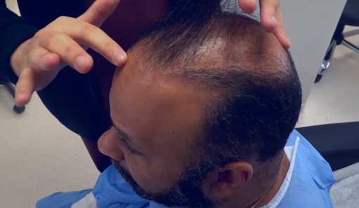 Our patient from Chad is very happy with the hair transplant treatment he received!